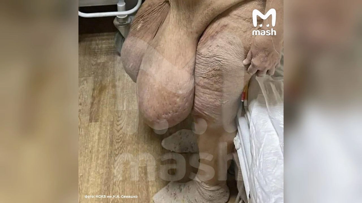 В Нижегородской области женщине удалили 20 кг поражённых тканей. Фото © Telegram/ Mash
