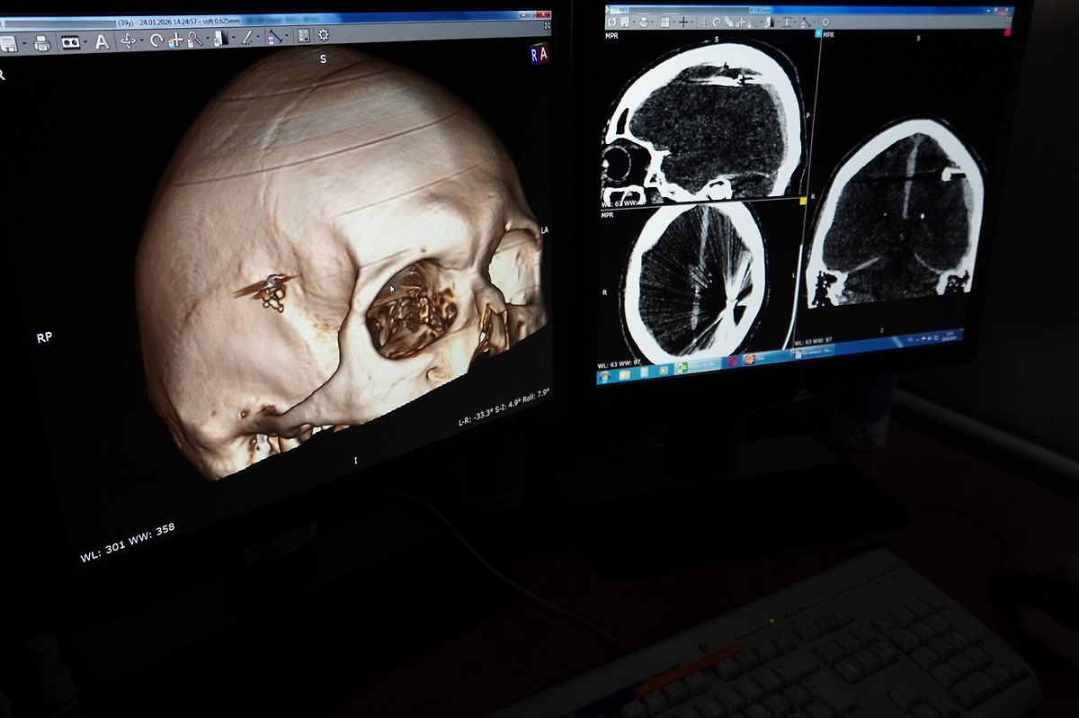 Нейрохирурги на Алтае спасли пациента с пулей. Фото © VK / КГБУЗ ККБСМП Барнаул