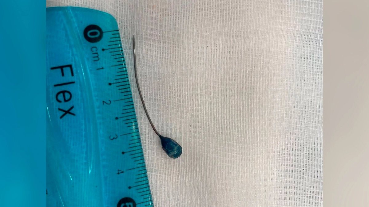 Проглоченная булавка. Фото © VK / Российская детская клиническая больница