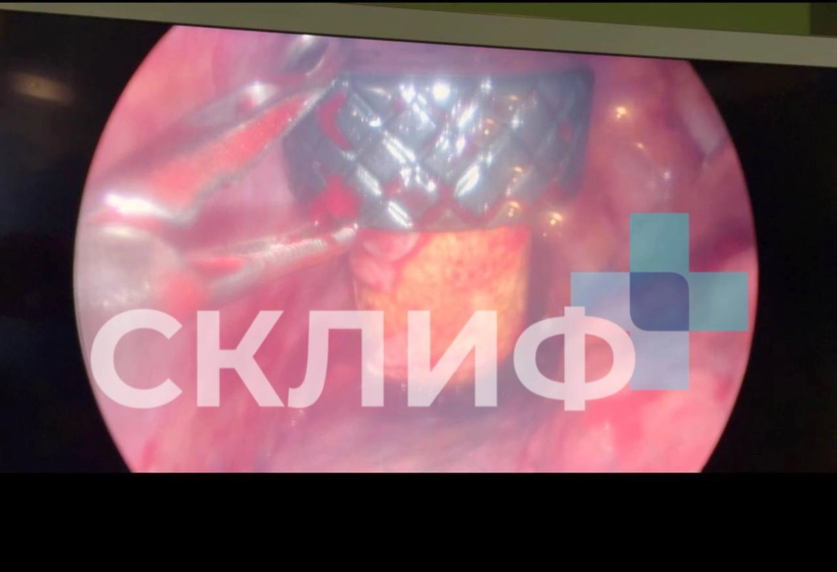 Пробка застряла в плевральной полости. Видео © Telegram / Склиф