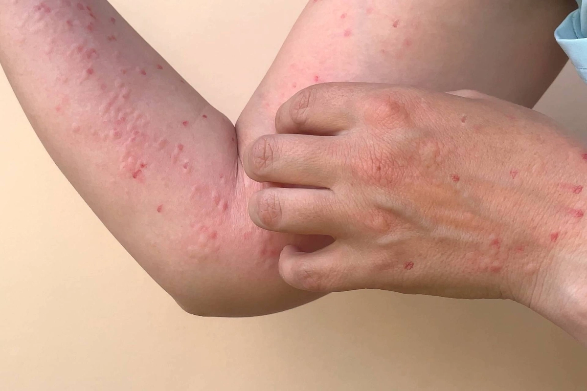 Как выглядит сыпь при оспе обезьян. Фото © Shutterstock / FOTODOM / Irina Starikova1811