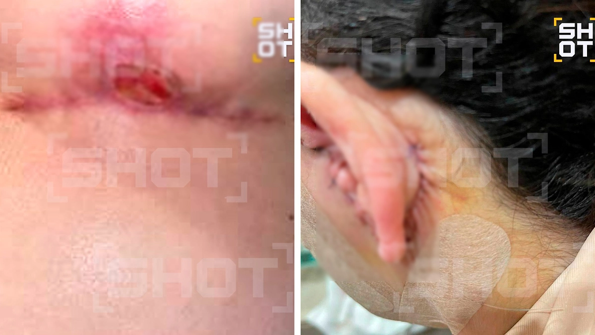 Последствия пластической операции у хирурга Авдеева. Фото © Telegram/ SHOT