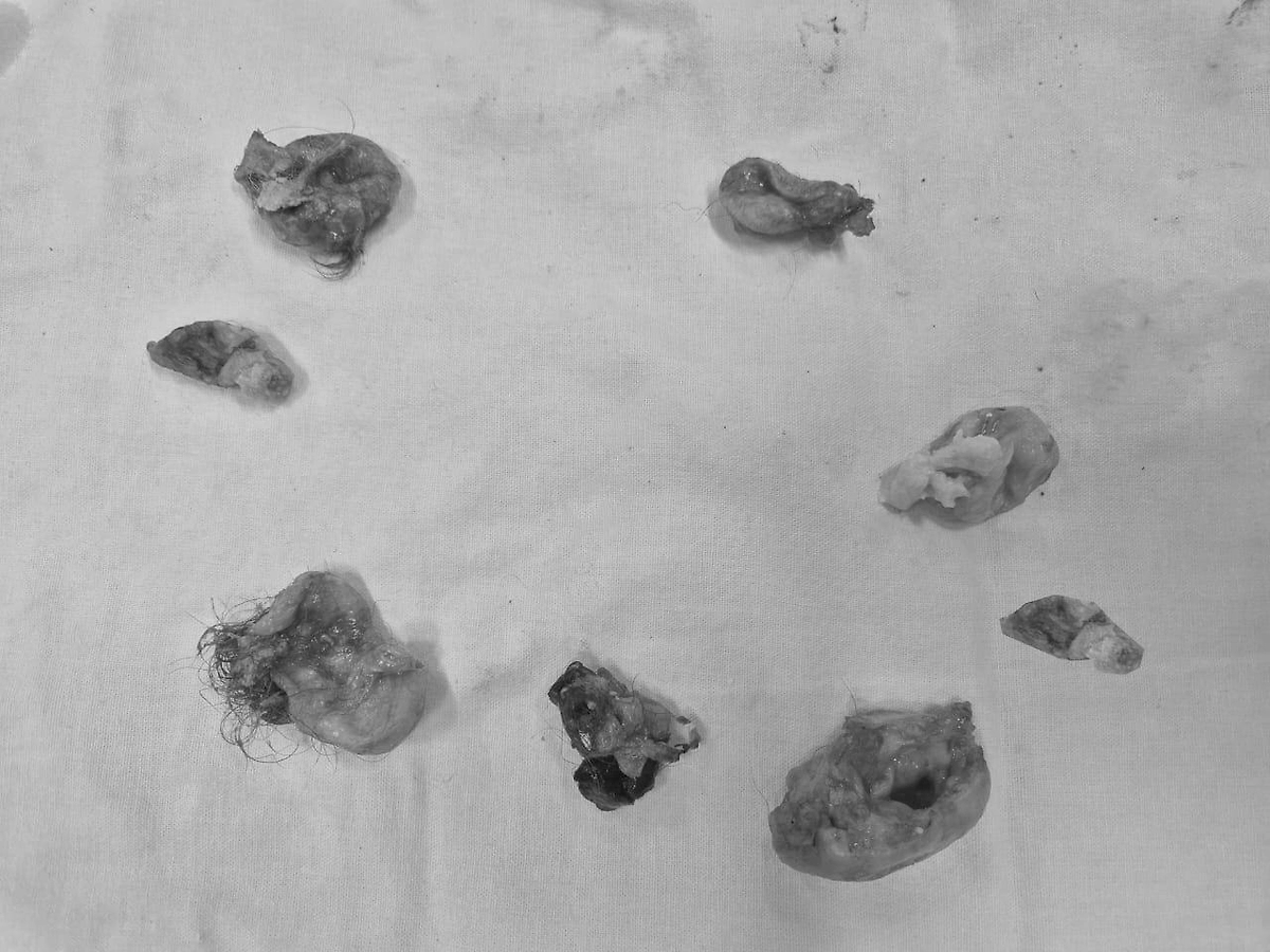 Удалённые кисты. Фото © Пресс-служба Минздрава Подмосковья