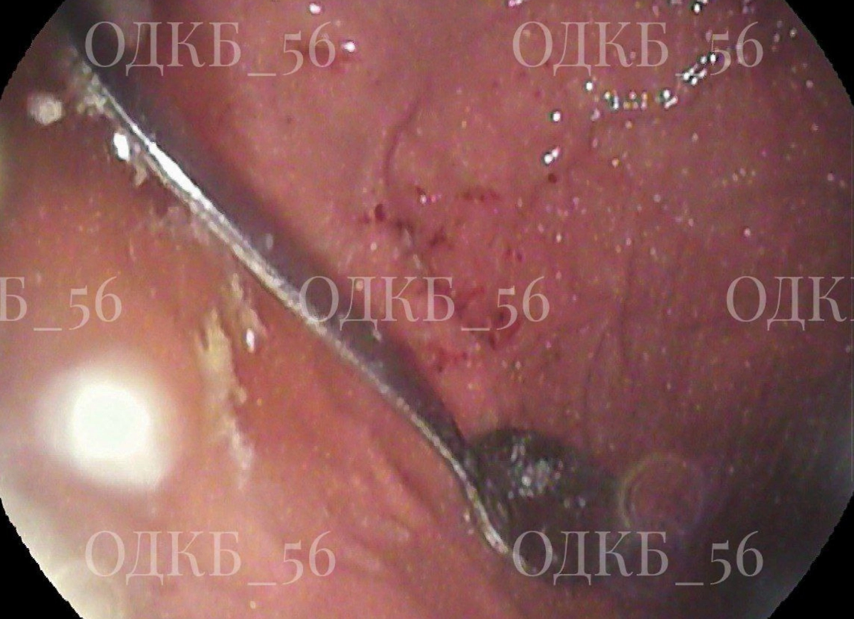 В Оренбурге врачи спасли ребёнка с 14-сантиметровой ложкой в желудке. Фото © Telegram / ОДКБ 56