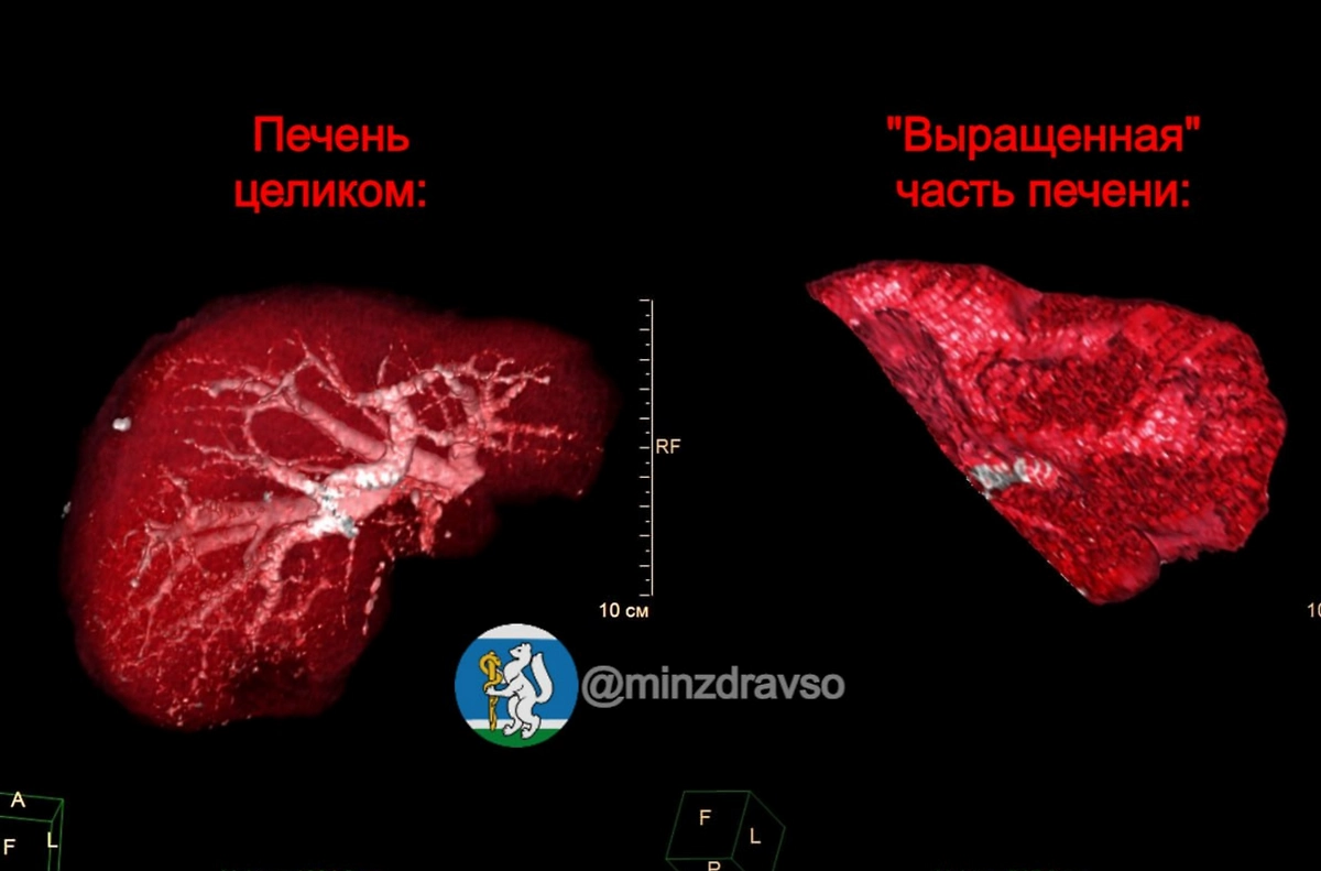 Онкобольному в Екатеринбурге «вырастили» часть печени для операции. Фото © Telegram / Здоровье уральцев
