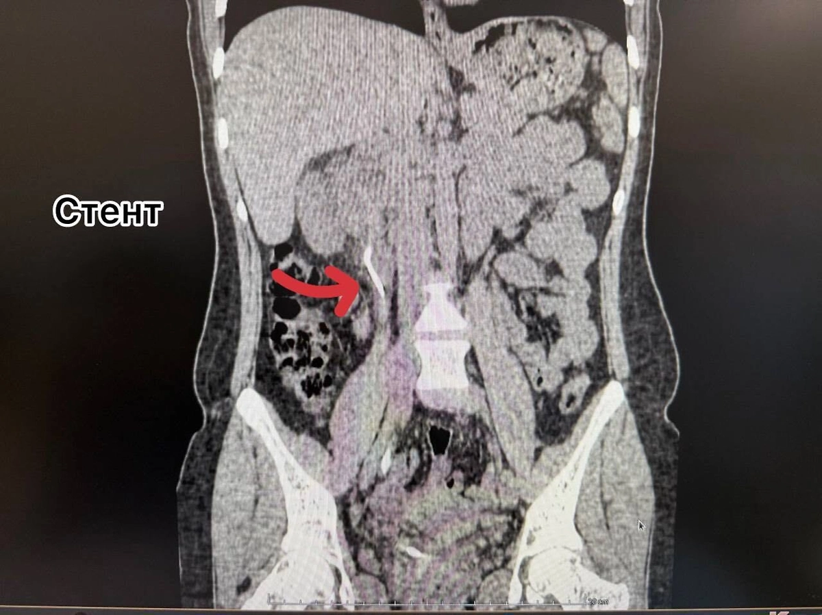 Рентген женщины с вросшим стентом во Владивостоке. Обложка © Telegram / Тысячекоечная больница г. Владивосток
