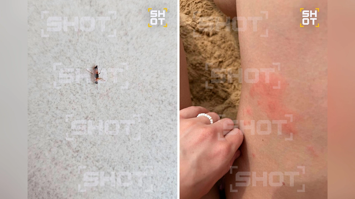 После укусов жуков остаются страшные ожоги. Фото © Telegram / SHOT