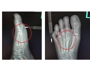 10-летний мальчик засадил иглу в стопу, вырезая печенье из «Игры в кальмара» 