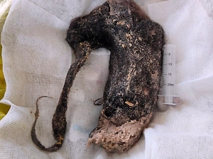 Нижегородская Рапунцель съела 3 кг своих волос, пока не слегла со страшным диагнозом