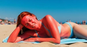 Как быстро снять солнечный ожог в домашних условиях — советы дерматолога