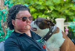 «Просто выгуливал собаку»: Американец с пересаженным лицом рассказал о загробном мире