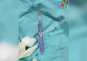 Россиянин проглотил зубную щётку и попал на операционный стол