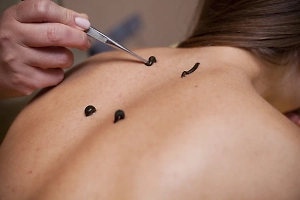 Лечение пиявками: Россиянам объяснили, почему процедуре не место в 21 веке