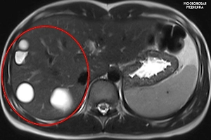 В Москве врачи спасли школьницу с множеством паразитарных кист в печени