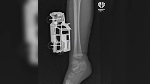 Московские врачи спасли ребёнка, которому в ногу впилась игрушечная машинка