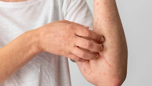 Врач объяснила, чем опасен «‎рецидив» ветрянки