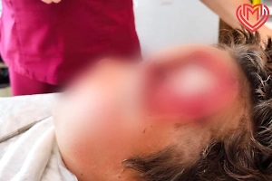 В Москве врачи спасли ребёнка, которому соседская овчарка выгрызла кусок лба