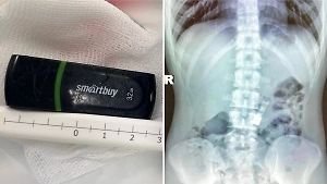 Школьник из Подмосковья случайно проглотил флешку с домашкой по информатике