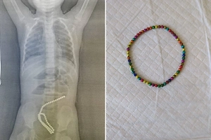 Двухлетняя россиянка проглотила рекордное количество магнитов