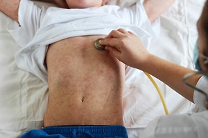 Более 60 детей заболели корью на севере Лондона, врачи бьют тревогу