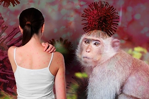 Обезьянья оспа (Mpox) в 2026 году: есть ли случаи в России, симптомы и профилактика на фоне случаев заражения в Подмосковье